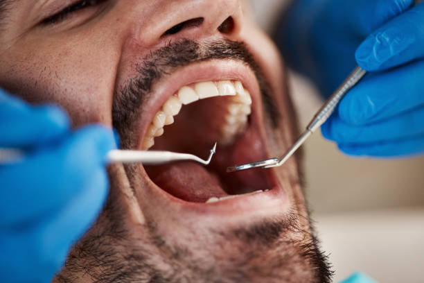 Best Emergency Broken Tooth Repair in Blue Mountain, MS
